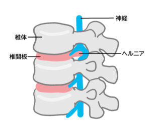 腰椎椎間板ヘルニアの状態(椎間板が後方に突出しているケース)を図式化したイラスト